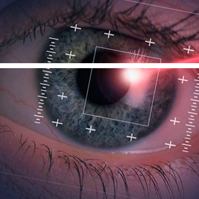 Intralasik procedure