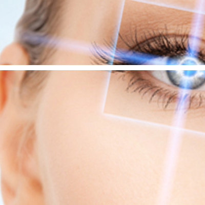 Laser correction eyes